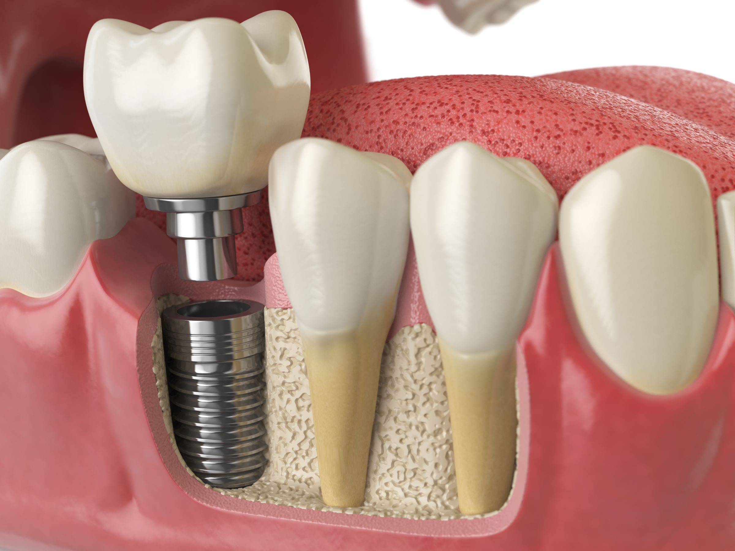 implantat naslovna slika